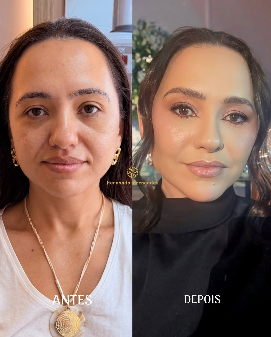 Resultado Harmonização Facial — Antes e Depois